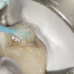 Figure 5 Rubber dam isolation to control the moisture, both in vapour and liquid forms, during a bonding procedure