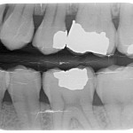 Figure 1 A bitewing image captured on a badly damaged photostimulable phosphor plate