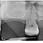 Figure 8 Artefact mimicking pathology