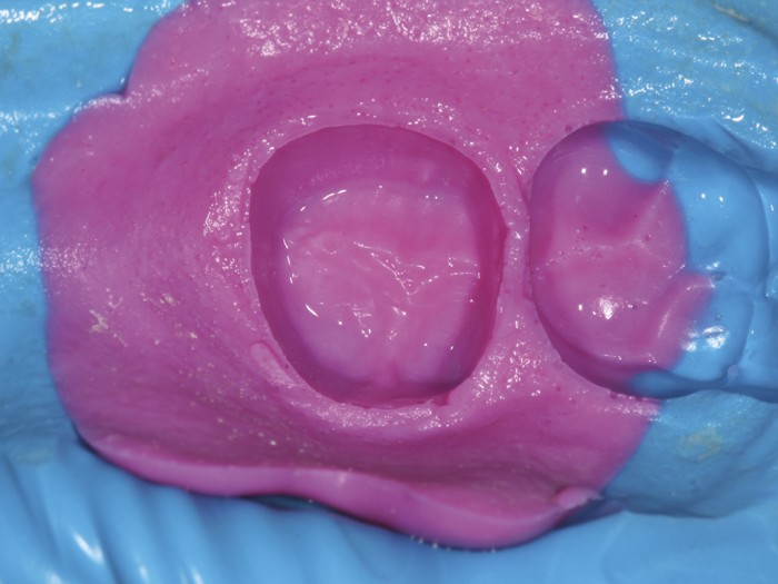 Material selection Scottish Dental magazine Scottish Dental magazine