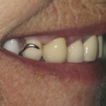Visible clasp from existing denture