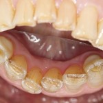 Composite rests lingually on lower canines