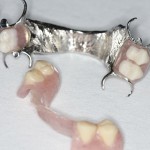 Existing removable restorations