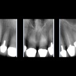 Radiographs of upper anteriors