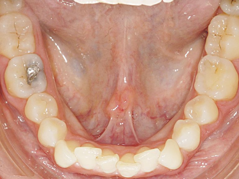 ClinicalLingualFig5e Scottish Dental magazine