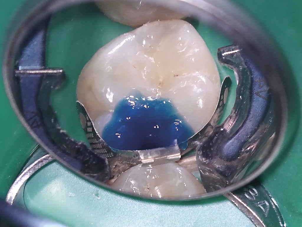 A V Ring (Triodent) sectional matrix placed and the cavity etched with Scotchbond Universal Etchant (3M ESPE)