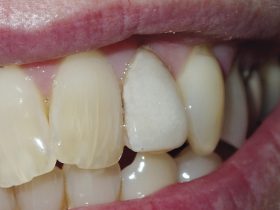 FIGURE 2: A middle-aged lady presented with a very white and unsightly porcelain veneer