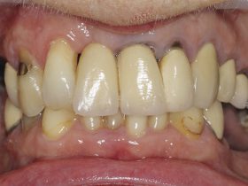 FIGURE 1: Failing crown and bridgework