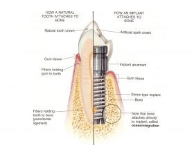 Figure 5: A comparison of how a natural tooth and an implant attaches to the bone