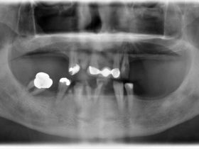 FIGURE 7: Are periodontitis patients more susceptible to periimplantitis