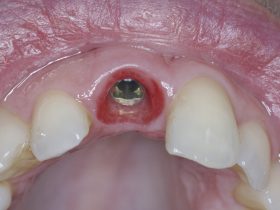 FIGURE 8: Perfectly healthy implant with more than 4mm pocket depth and BoP