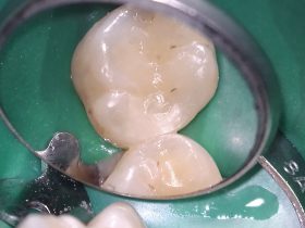 FIGURE 1: 16 DO cavity restored with Filtek P60 Posterior Restorative (3M ESPE) after gross finishing but before the rubber dam had been removed