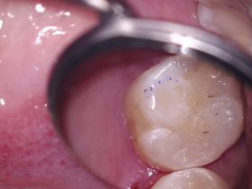 FIGURE 7: The completed 16DO Filtek™ Bulk Fill Posterior (3M ESPE)