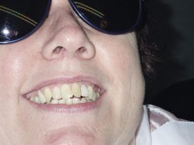 FIGURE 3: The patient requested to have the existing veneer replaced