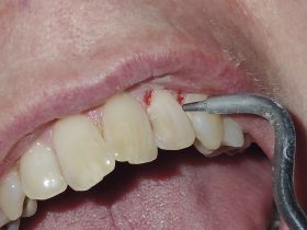 FIGURE 5: Air abrasion is used on the labial surface of the tooth