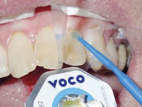 FIGURE 6: Bonding agent is applied to the tooth surface