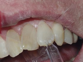 FIGURE 9: After administering the dentine composite to the tooth surface, the template is carefully seated before removing any excess material