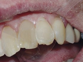 FIGURE 10: After light curing, the template is removed and a finishing bur can then excise any flash at the margin. Care must be taken not to touch the facial surface of the restoration