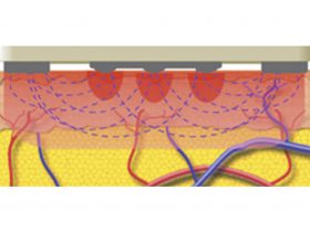 FIGURE 3: Representation of alternating current flowing between the positive (central) electrodes and negative (side) return plates