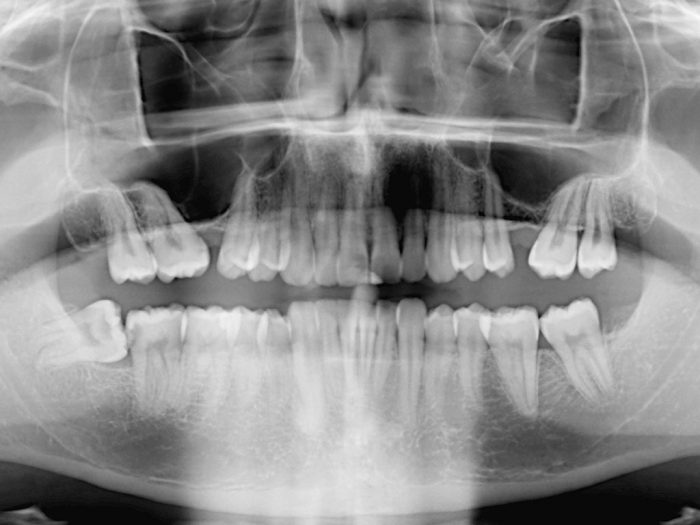 The coronectomy technique Scottish Dental magazine Scottish Dental