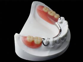 FIGURE 1 – Removable partial chrome cobalt denture