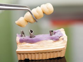 FIGURE 2 Extended implant fixed partial denture