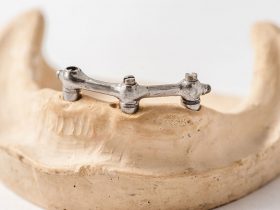 FIGURE 3 Lower implant over-denture bar