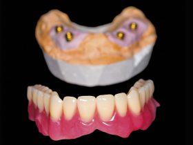 FIGURE 4 Implant-retained over-denture