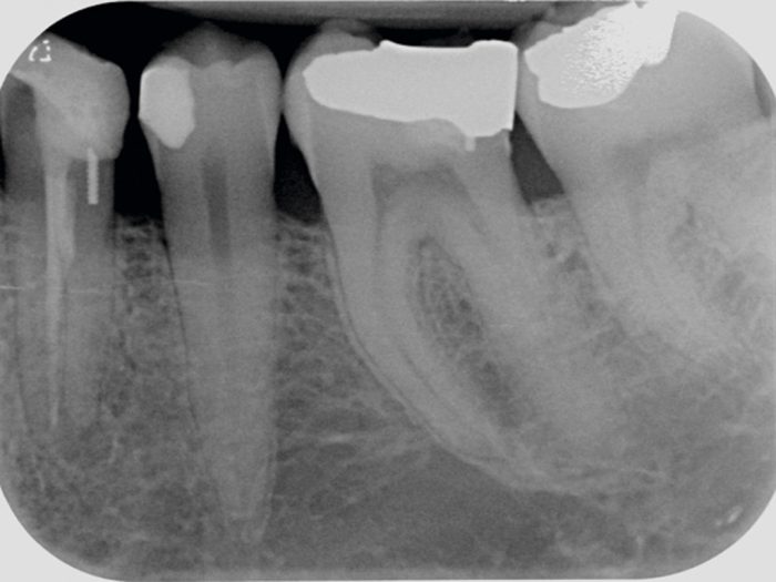 Figure 2: LL4 pre-op radiograph