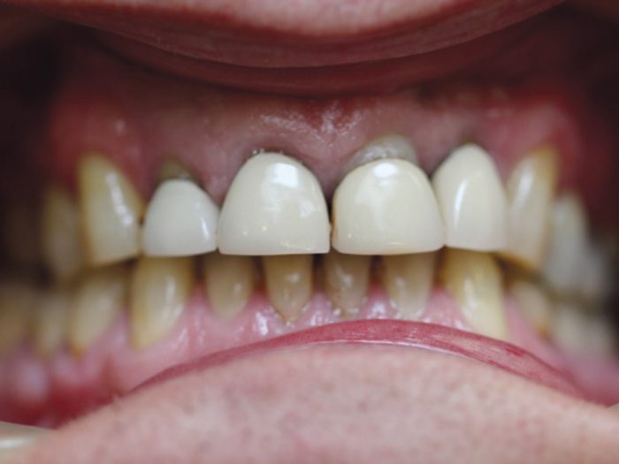 Figures 1 a-c: Inra-oral clinical photographs