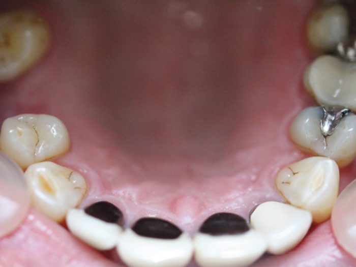 Figures 1 a-c: Inra-oral clinical photographs