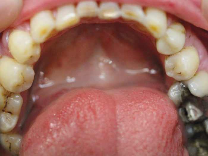 Figures 1 a-c: Inra-oral clinical photographs