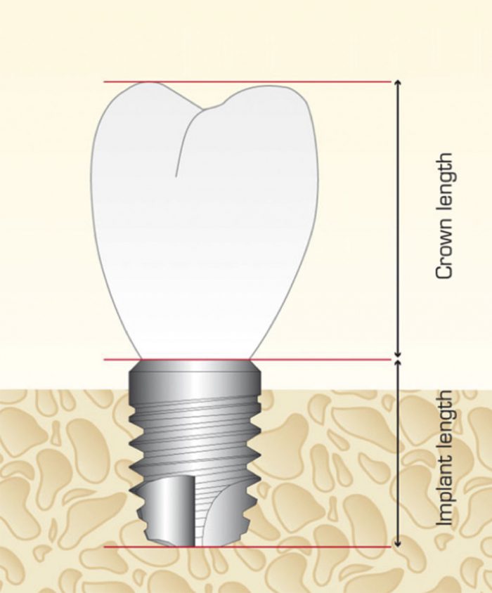 Crowntoimplant ratio Scottish Dental magazine Scottish Dental