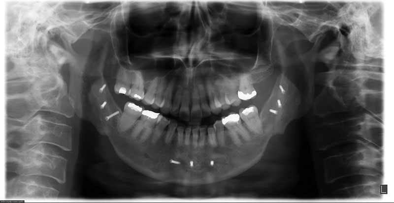 first bite syndrome