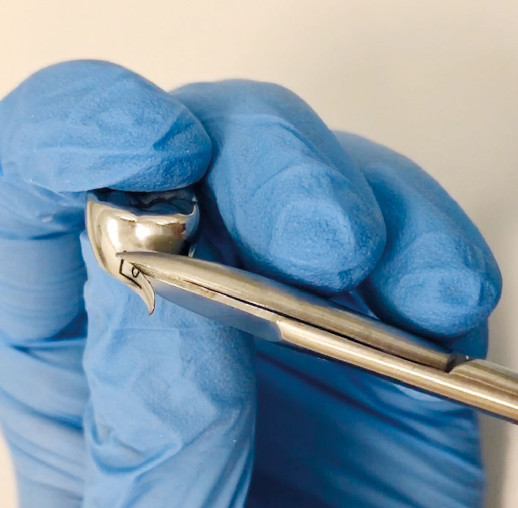 Use of stainless steel crowns in the permanent dentition of paediatric