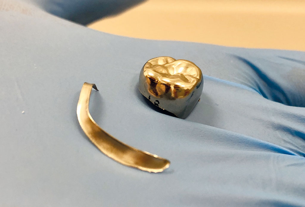 Use of stainless steel crowns in the permanent dentition of paediatric