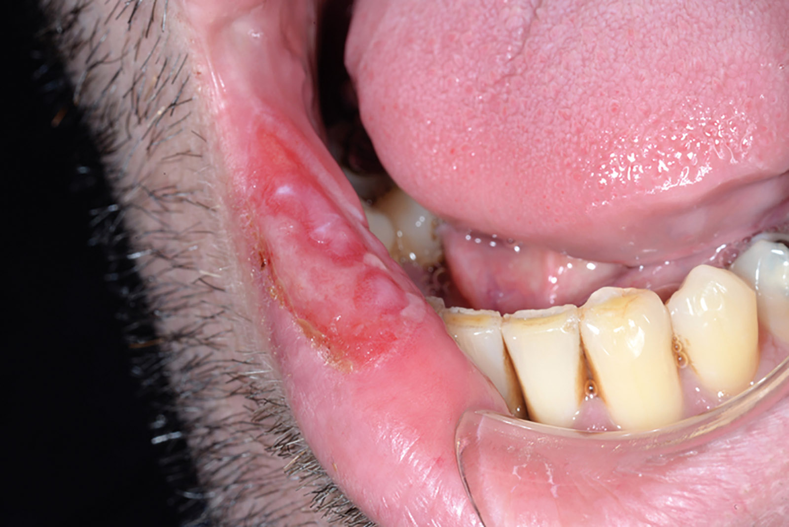 Syphilis Chancre Tongue