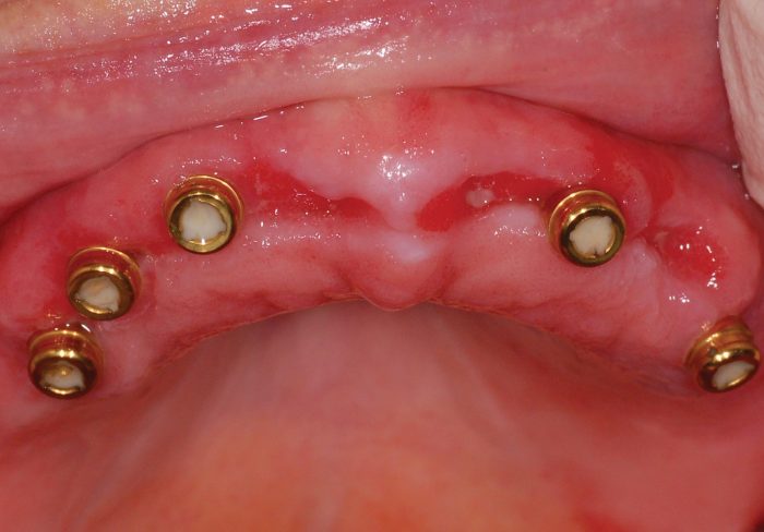 Figure 12: Following three weeks of undisturbed healing