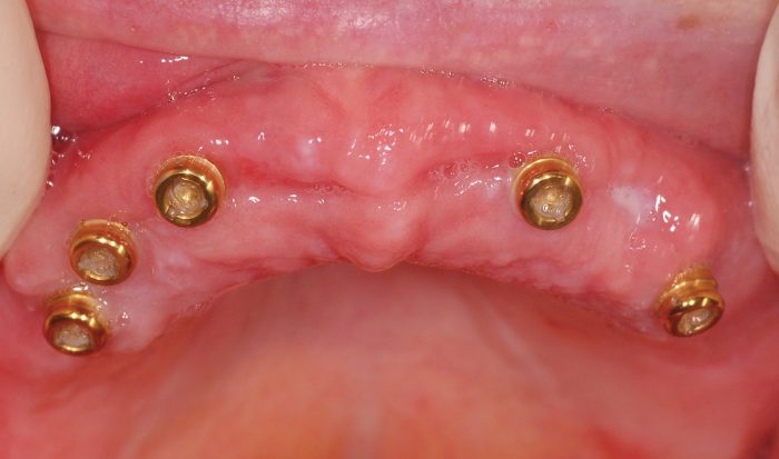 Figure 13: Following 12 weeks of complete healing