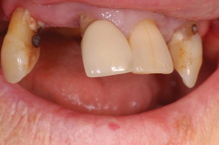 Figure 2: Intra-oral view of remaining maxillary teeth