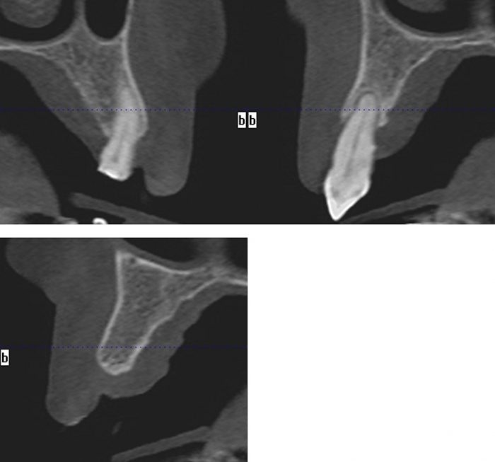 Figure 4: A CBCT scan of the upper jaw was taken to accurately assess the anatomy, bone volume and trajectory of the alveolar ridges