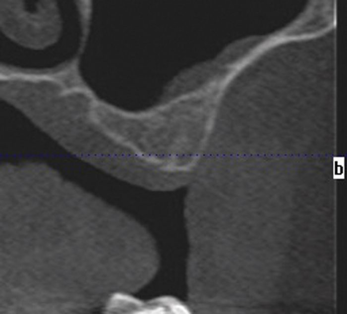 Figure 5: Inadequate bone below the maxillary sinuses