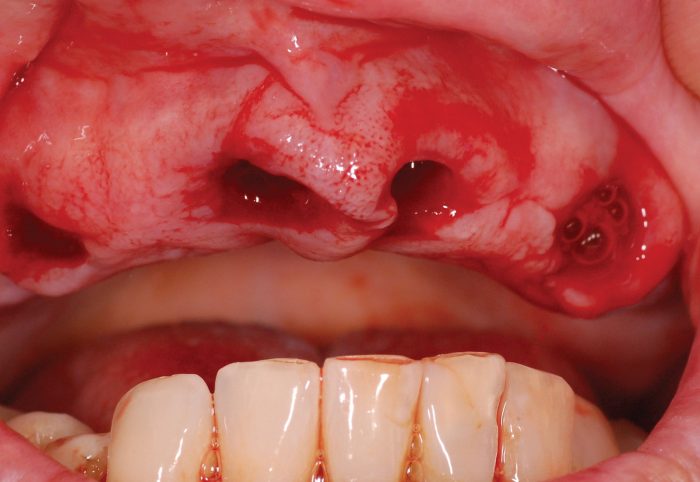 Figure 6: Immediate extraction sockets