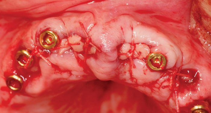Figure 7: Implants placed, and Locator abutments attached