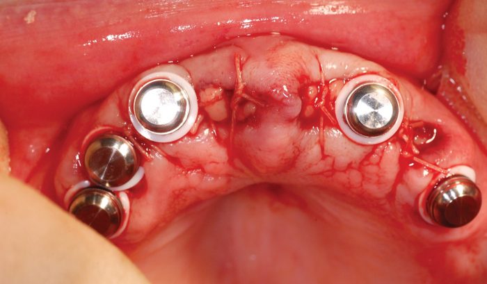 Figure 8: Metal housing on Locator abutments just before pick-up in the denture