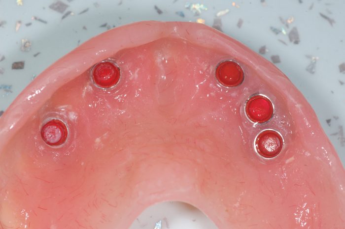 Figure 9: Metal housing precisely secured in the denture