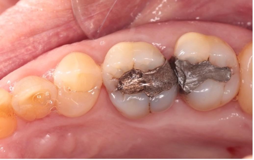Ceramic onlays indications and adhesive principles Scottish Dental